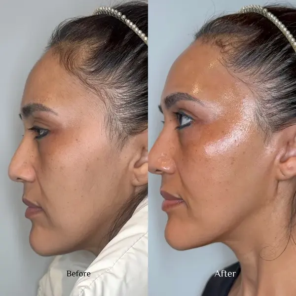 hydrafacial-before-and-after-1 hydrafacial in San Antonio, TX