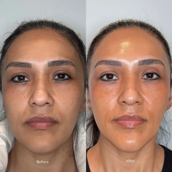 hydrafacial-before-and-after-2 hydrafacial in San Antonio, TX
