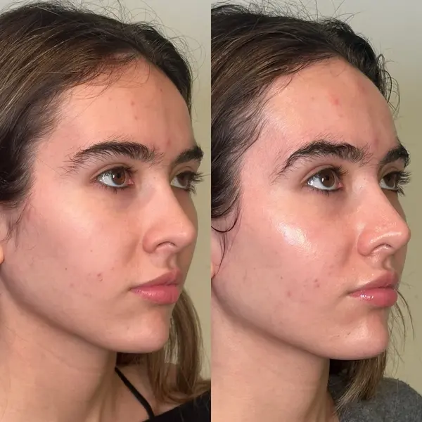 hydrafacial-before-and-after-3 hydrafacial in San Antonio, TX