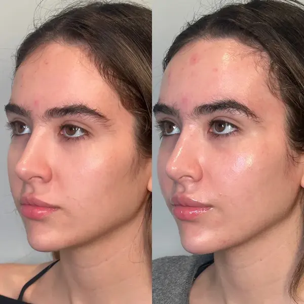 hydrafacial-before-and-after-4 hydrafacial in San Antonio, TX