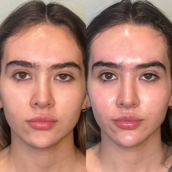 hydrafacial-before-and-after-5 hydrafacial in San Antonio, TX