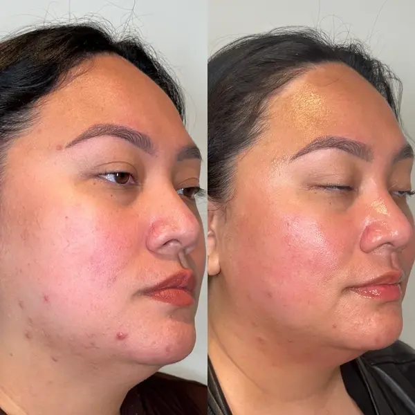 hydrafacial-before-and-after-6 hydrafacial in San Antonio, TX