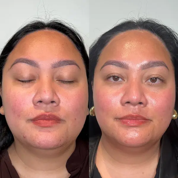 hydrafacial-before-and-after-7 hydrafacial in San Antonio, TX